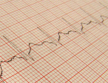 heart electrocardiogram