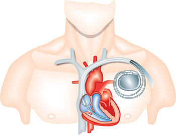 Pacemaker implanted in heart